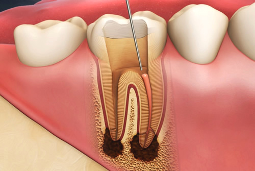L’endodonzia