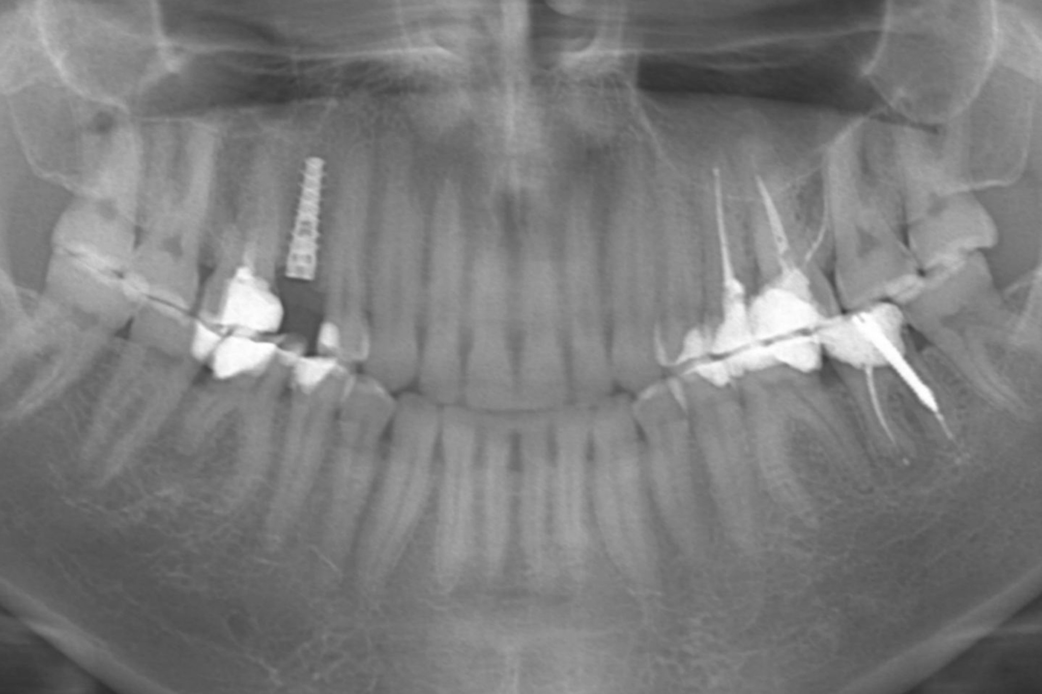 Implantul dentar şi tot ce trebuie sa ştim despre acesta